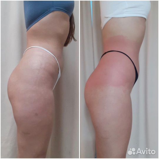 Антицеллюлитный Массаж