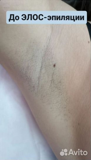 Лазерная эпиляция