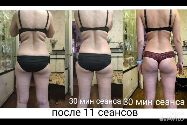 Антицеллюлитный массаж и коррекция фигуры