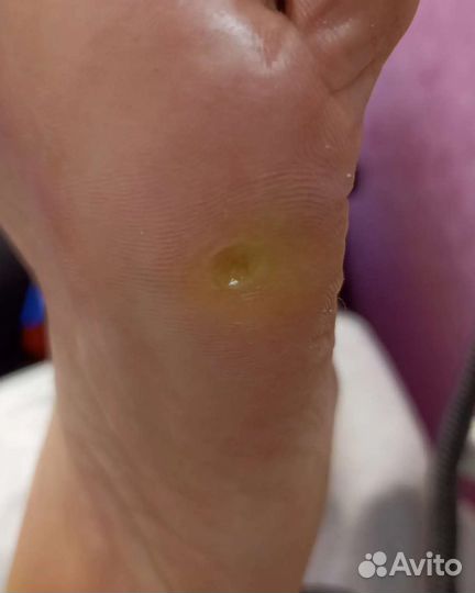 Подолог. Педикюр, вросший ноготь, сложные стопы