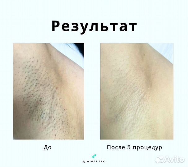 Диодный лазер Лю'Минес Макс’Ван 1200