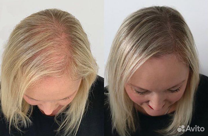 Трихопигментация женская загущение волос