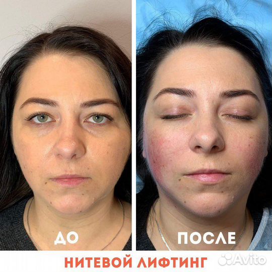 Нитевой лифтинг