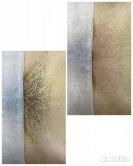 Удаление волос