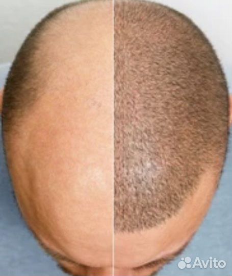 Обучение Трихопигментации