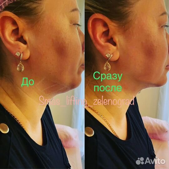 Смас лифтинг лицо тело Альтера