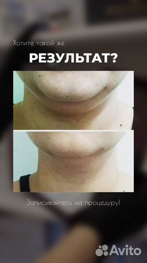 Липолитики тело/лицо