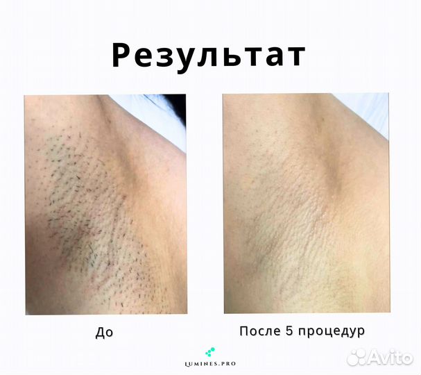 Аппарат для эпиляции Lumines Макс Ван 1200W