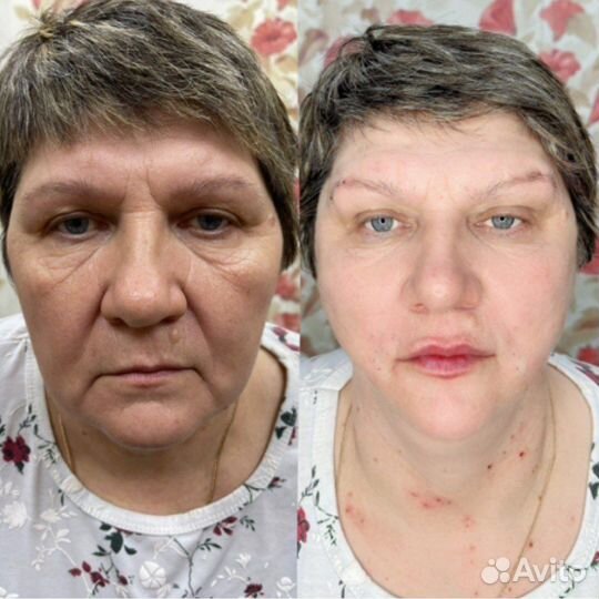 Нитевой лифтинг