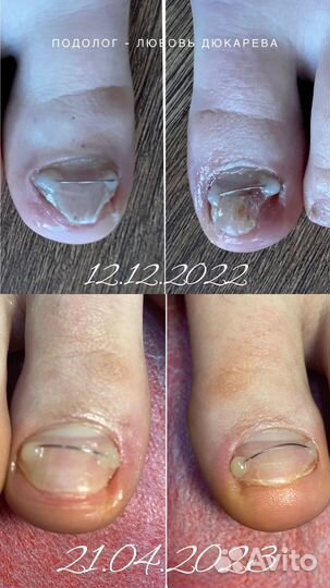 Подолог Медицинский педикюр Вросший ноготь