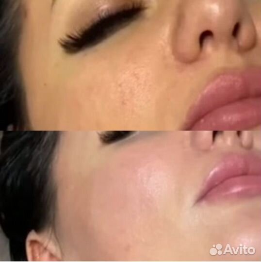 Чистка лица пилинг косметолог мезотерапия