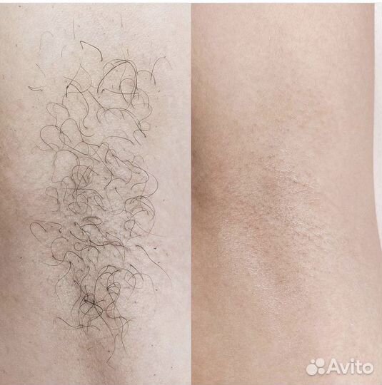 Удаление волос