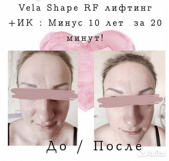 Массаж LPG на аппарате Vela Shape