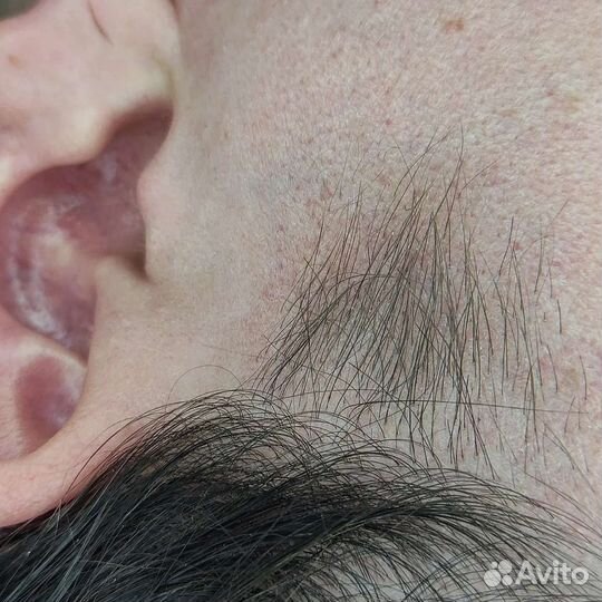 Электроэпиляция apilus