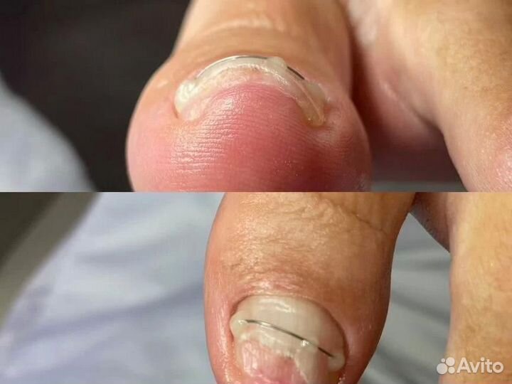 Лечение ногтей на ногах, подолог