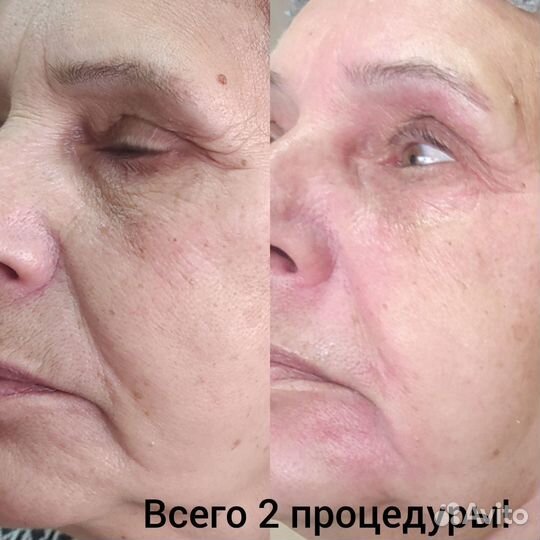 FlaxLift Обучение косметолог. уход. процедуре