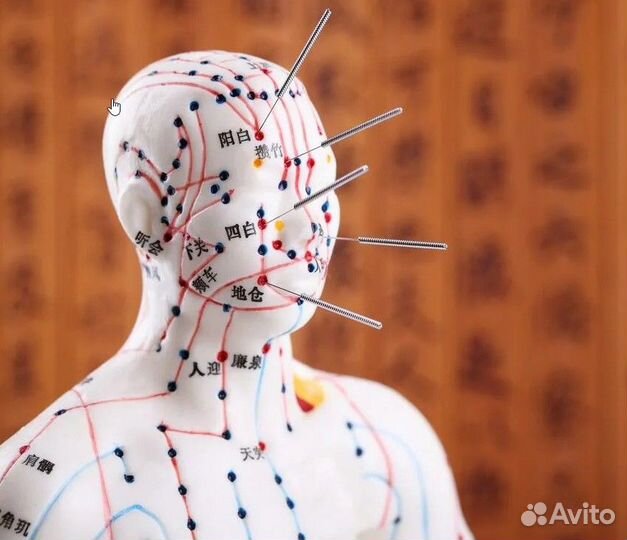 Иглоукалывание