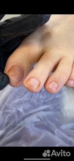 Требуются модели на удаление вросшего ногтя