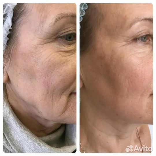 Омоложение Подтяжка лица СМАС лифтинг