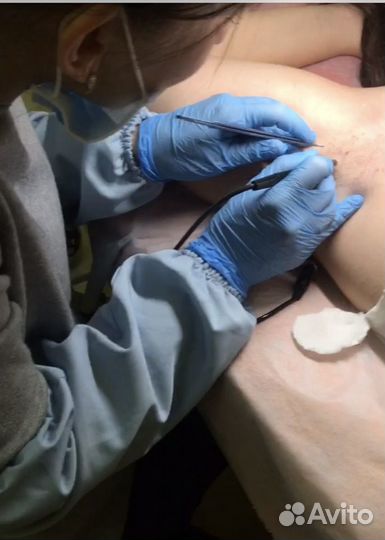 Курсы обучение электроэпиляции