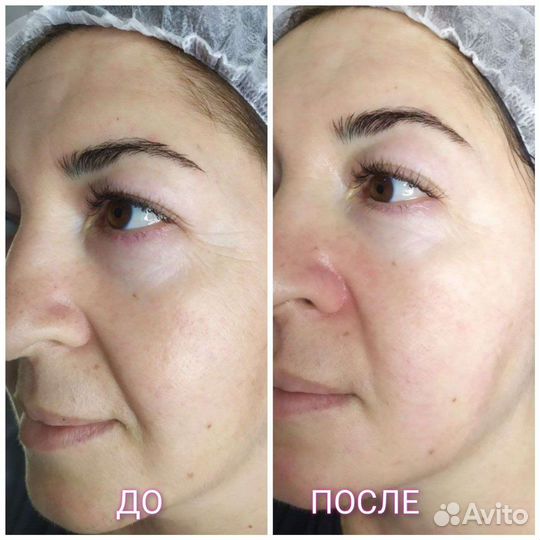 Смас-лифтинг (smas-лифтинг)