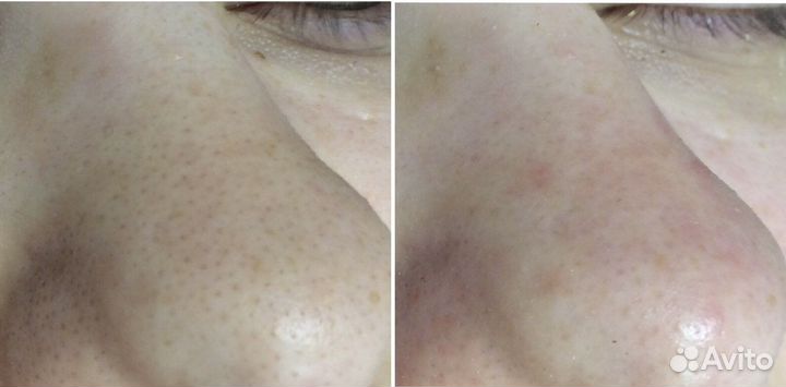 Комбинированная чистка лица