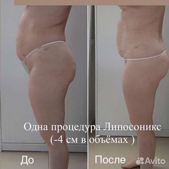 Липосоникс отзывы фото до и после