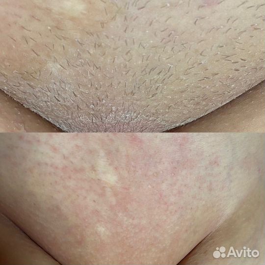 Шугаринг/Ваксинг