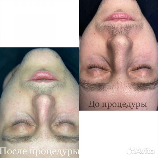 Чистка кожи лица, спины, пилинг