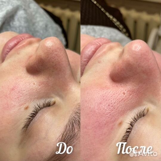 Чистка лица модель