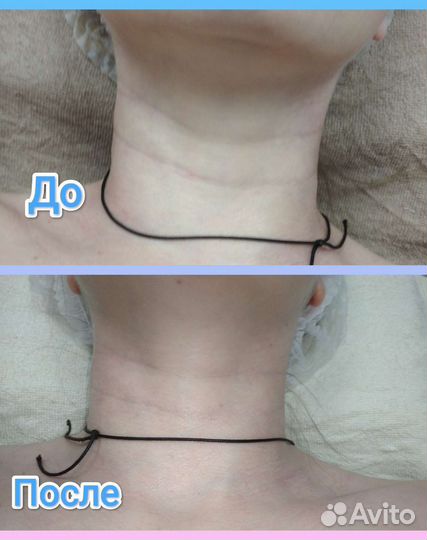 Массаж лица (омолаживающий)