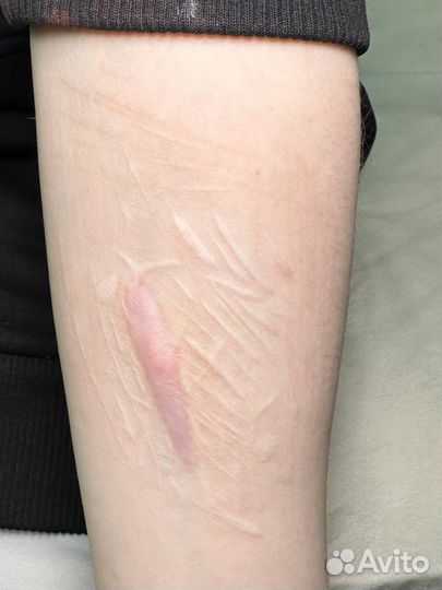 Коррекция шрамов, рубцов (авторская методика)