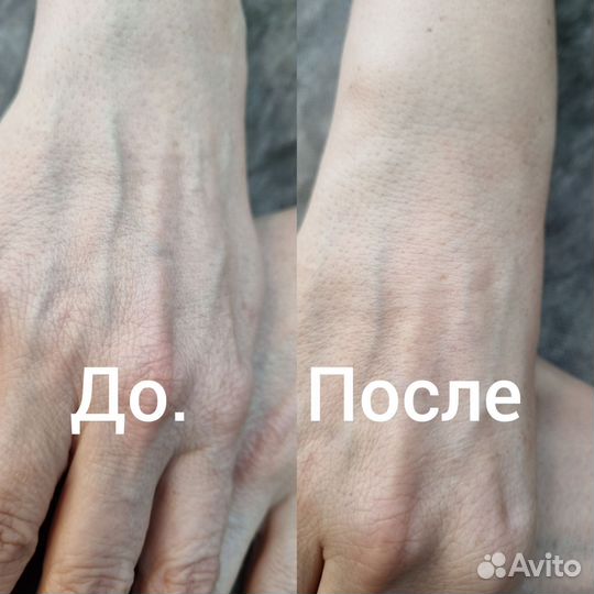 Удаление татуажа