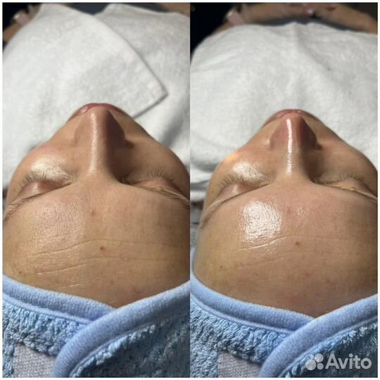 Чистка лица, маски, пилинг, hydrafacial