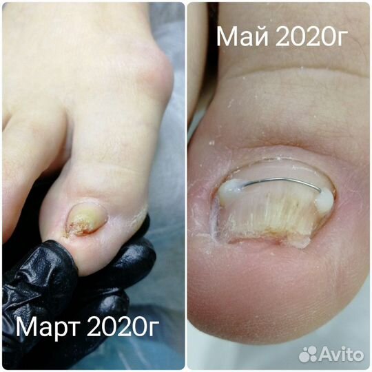 Лечебный педикюр