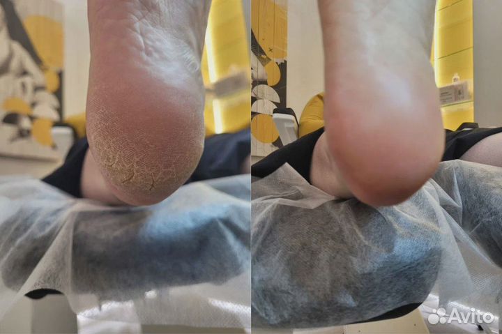 Медицинский педикюр / Подология