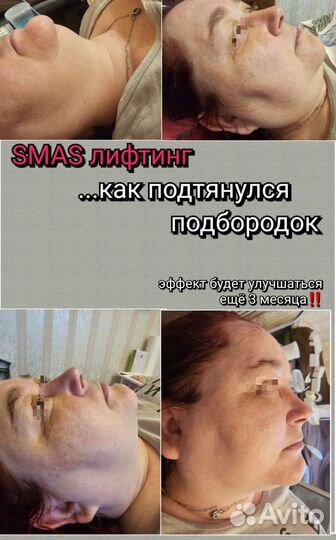 SMAS лифтинг лица и тела