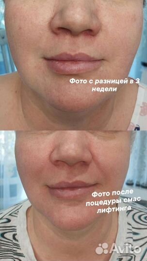 Косметолог. SMAS лифтинг