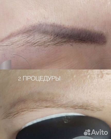 Лазерное удаление тату и татуажа. Ремувер