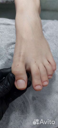 Лечебный педикюр,онихолизис,вросший ноготьбородавк