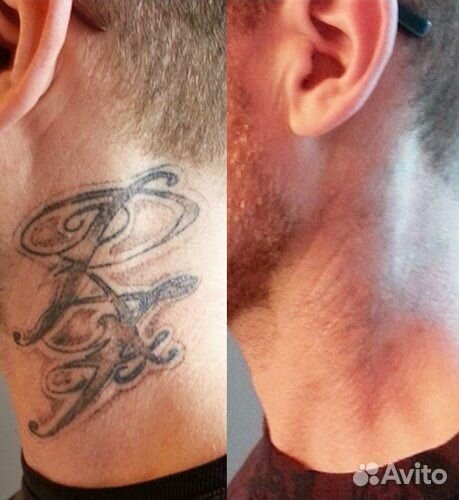 Лазерное удаление тату