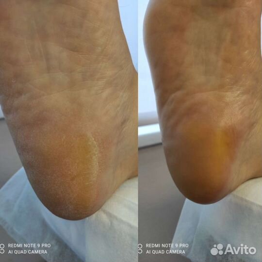 Депиляция Педикюр Подология Титановая нить