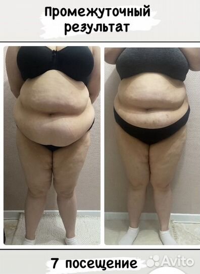 Аппаратный массаж