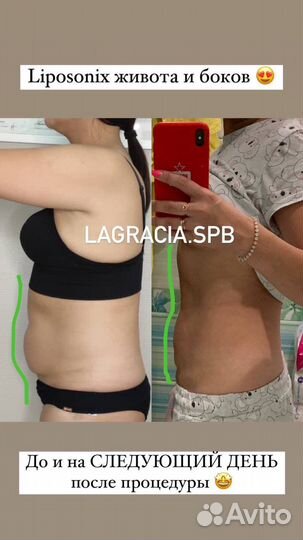 Липосоникс