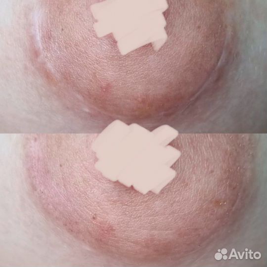 Камуфляж шрамов, рубцов, растяжек, витилиго