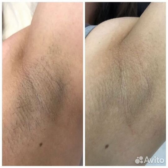 Лазерная эпиляция диодный лазер