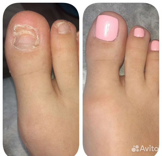 Коррекция вросшего ногтя Подолог