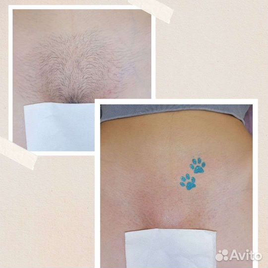 Депиляция Шугаринг