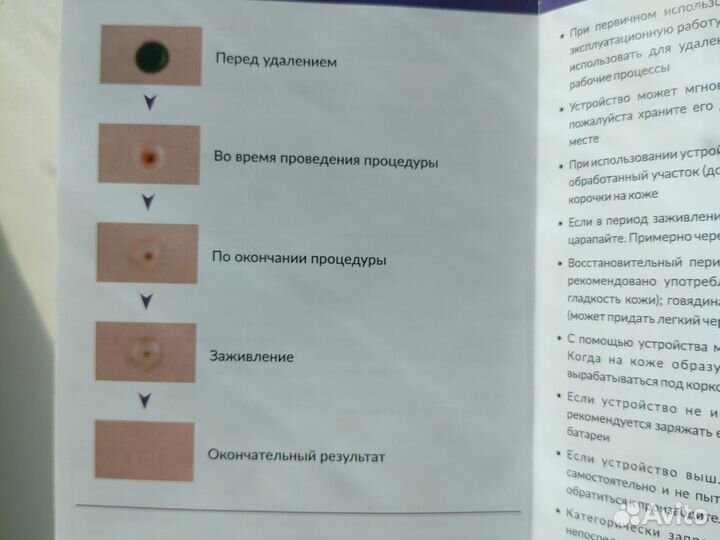 Лазерная ручка для удаления папиллом и родинок