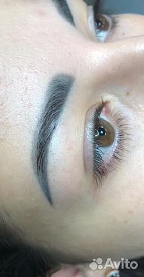 Лазерное удаление пм и татуировок